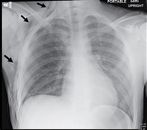 Where’s the air? Pneumothorax | Radiology Key