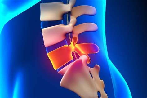 Bulging Disc L4/L5 - Symptoms and Treatment