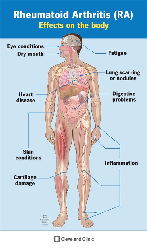 Understanding Arthritis: Causes, Symptoms, And Treatment - Ask The ...