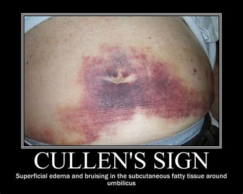 Cullen Sign seen in pancreatitis | Nurse practioner, Ovarian cyst, Ovarian