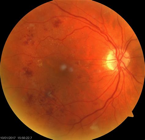 Back to Basics-Diabetic retinopathy - Sydney Ophthalmic Specialists