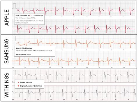 Atrial Flutter Vs Atrial Fibrillation Ecg