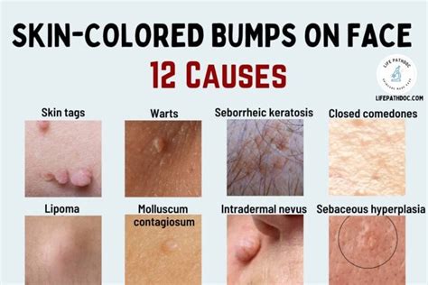 Skin Colored Bumps on Face: 12 Causes, Pictures & Treatment