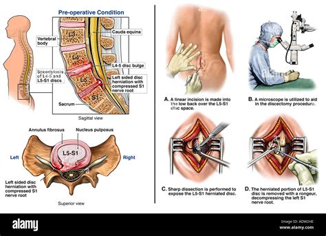 L5-S1 Lumbar Disc Herniation with Microdiscectomy Repair Stock Photo ...