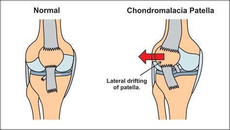 Chondromalacia Patella Surgery