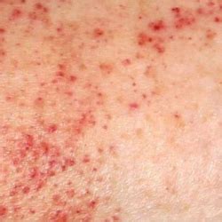 Treating Clients With Petechiae | ASCP Skin Care Professionals