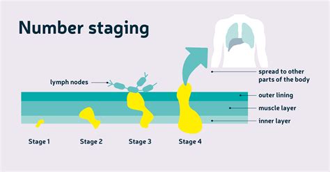 Staging & grading | Diagnosis | About bowel cancer | Bowel Cancer UK