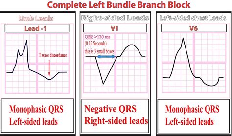 Bundle Branch Block - Causes, Symptoms, Diagnosis, Treatment