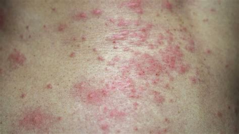 Bacterial Skin Rash Symptoms And Treatment Detailed Review – NBKomputer