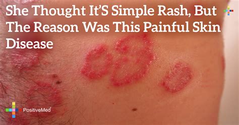 Skin Rashes Identification Pictures