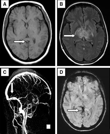 a MRI brain T1 axial—bilateral internal cerebral vein thrombosis, b T2 ...