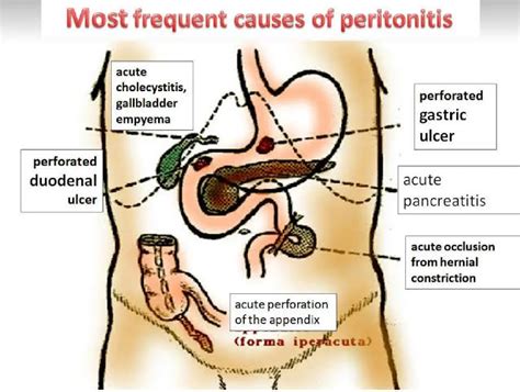 Peritonitis - Symptoms, Causes, Complications & Treatment - Santripty