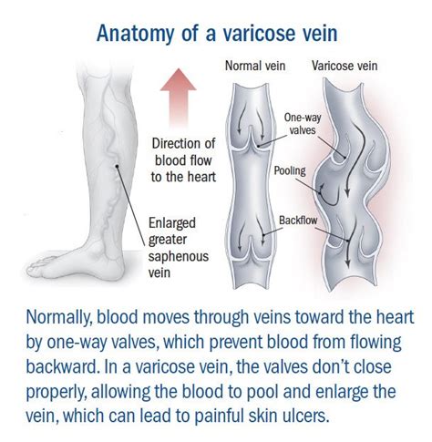 Varicose veins Guide: Causes, Symptoms and Treatment Options