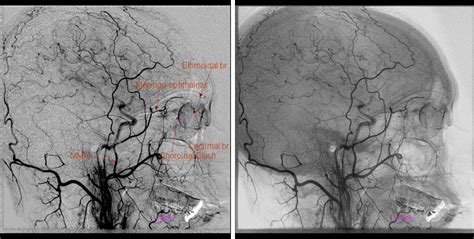 Middle Meningeal Artery | neuroangio.org