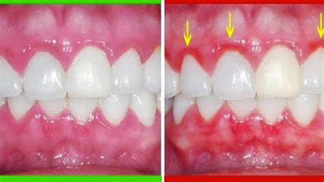 Caring for Red and Swollen Gums | Periodontal Disease Treatment Houston TX