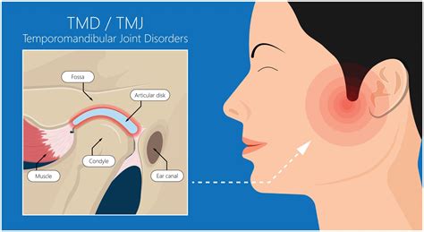 TMJ Treatment Houston | TMJ Disorders Houston TX | TMJ Specialist in ...