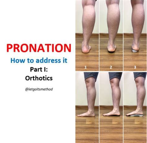 What Causes Pronation Of Foot