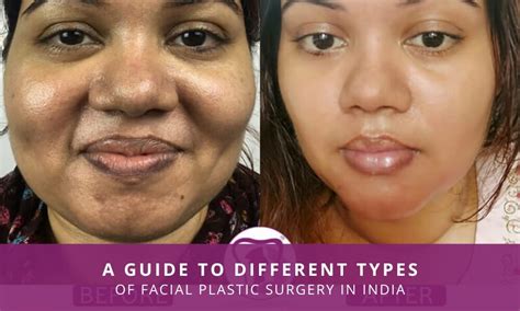 A Guide to Different Types of Facial Plastic Surgery in India ...