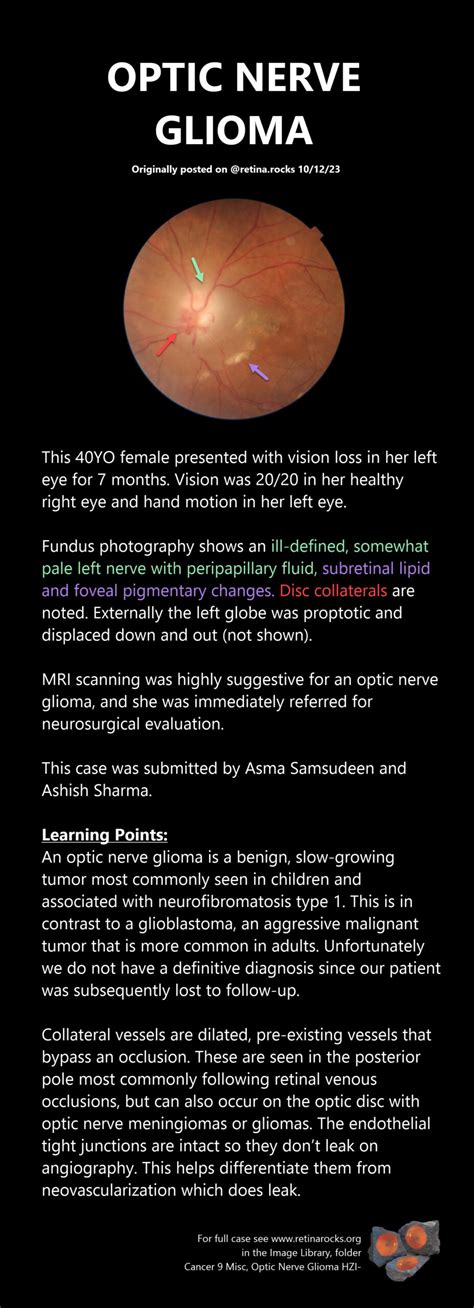 Optic Nerve Disorders > Optic Nerve Glioma - Retina Rocks