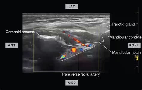 Facial Nerve Ultrasound