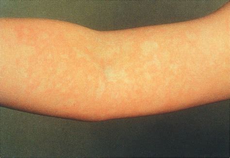 Erythema Infectiousum (Fifth Disease, Slapped Cheek Syndrome ...