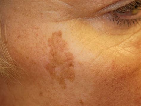 Age spots: Causes, symptoms, and treatment