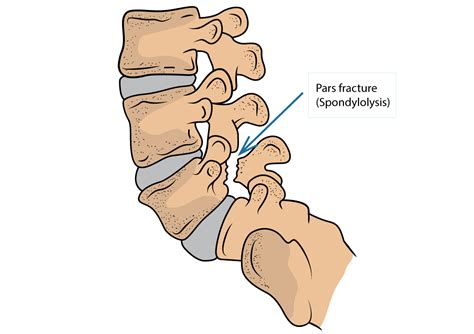 Pars Fracture (Spondylolysis) and Spondylolisthesis | Dr Yu Chao Lee