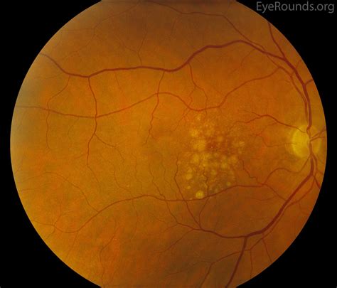 Age-related macular degeneration