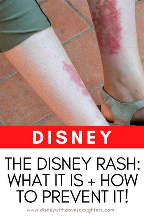 Disney Rash: How to Treat and Prevent - Disney With Dave's Daughters