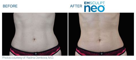 Emsculpt NEO Before and After | Real Patient Results