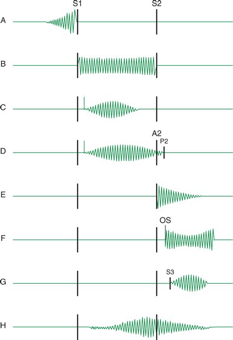 Approach to the Patient with a Heart Murmur | Thoracic Key