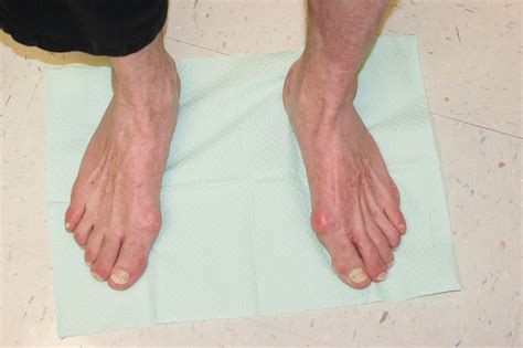 Evaluation of Peripheral Neuropathy in the Diabetic… | Relias Media