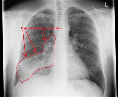 Pneumonia chest x ray - wikidoc