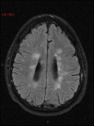 Dawson fingers | Radiology Reference Article | Radiopaedia.org