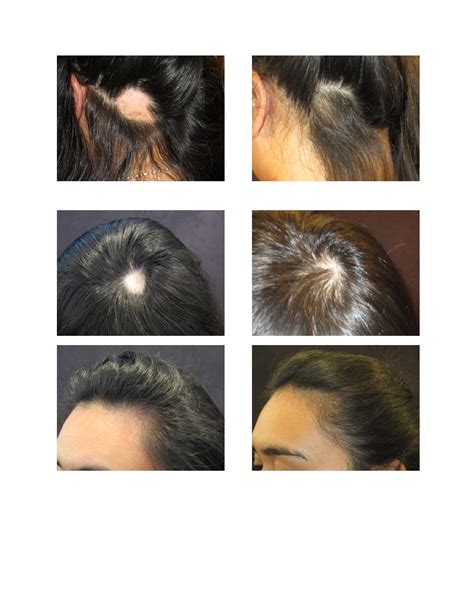 Alopecia Areata and Hair Loss Treatments - Absolique Hair Health Clinic