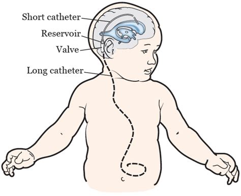 Hydrocephalus Shunt