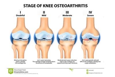 Knee Replacement Pinehurst, NC | Knee Surgery Pinehurst, NC