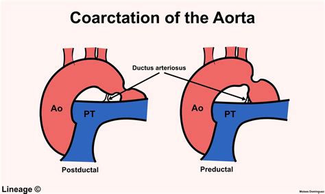 Coarctation of the Aorta - Cardiovascular - Medbullets Step 1