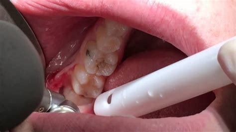 Signs You Need To Have Your Wisdom Tooth Taken Out - Collected By Tas-ka