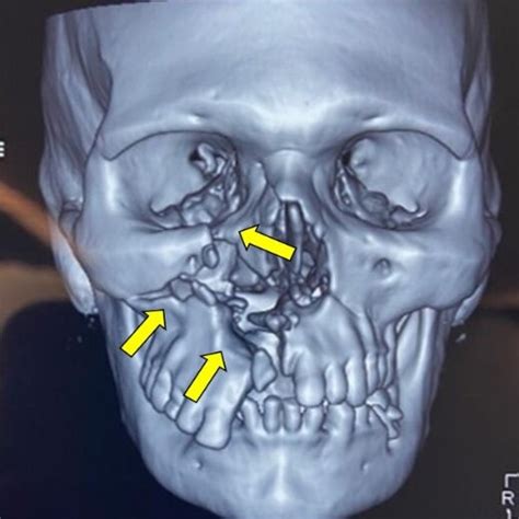 Depicts Le fort II fracture on the right side, the fracture lines ...