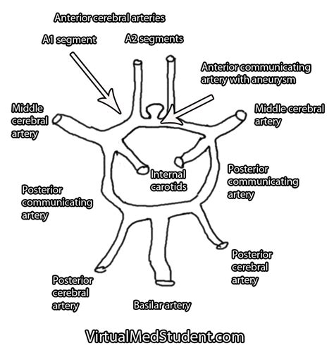 VirtualMedStudent.com || Anterior Communicating Artery Aneurysms