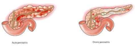 Pancreatitis - AGA GI Patient Center