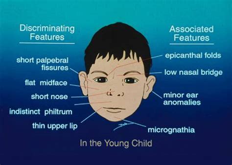 About Down Syndrome - Anatomy & Physiology