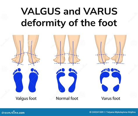 Varus And Valgus Deformity Of The Foot Cartoon Vector | CartoonDealer ...