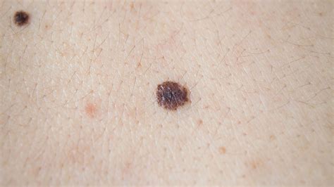 Melanoma | AkshaAillidh