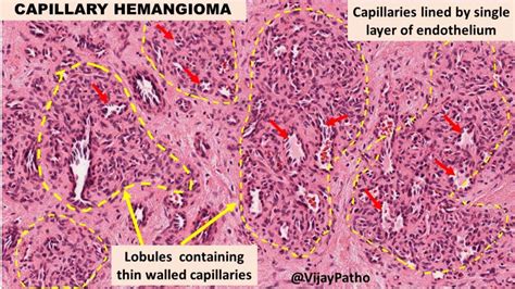 Capillary Hemangioma - Pathology Made Simple