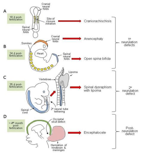 Neural Tube Defects - Neuropedia - Neuropathology