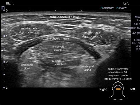 Parotid Gland Ultrasound Measurement