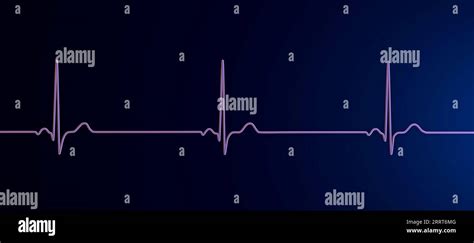 Ritmo cardíaco de bradicardia sinusal, ilustración Fotografía de stock ...