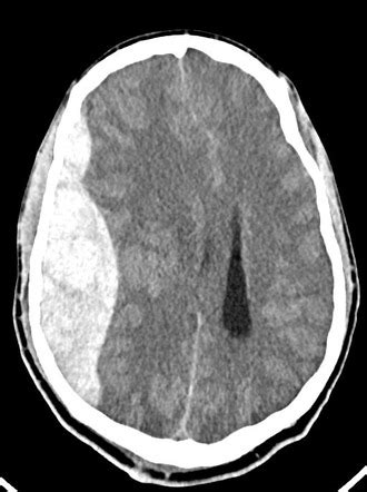 Epidural hematoma due to middle meningeal artery injury | Radiology ...